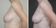 Dr. Kao Breast Reduction