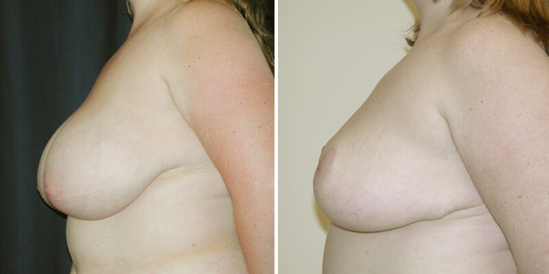 Dr. Kao Breast Reduction