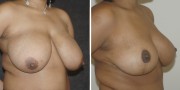 Dr. Kao Breast Reduction