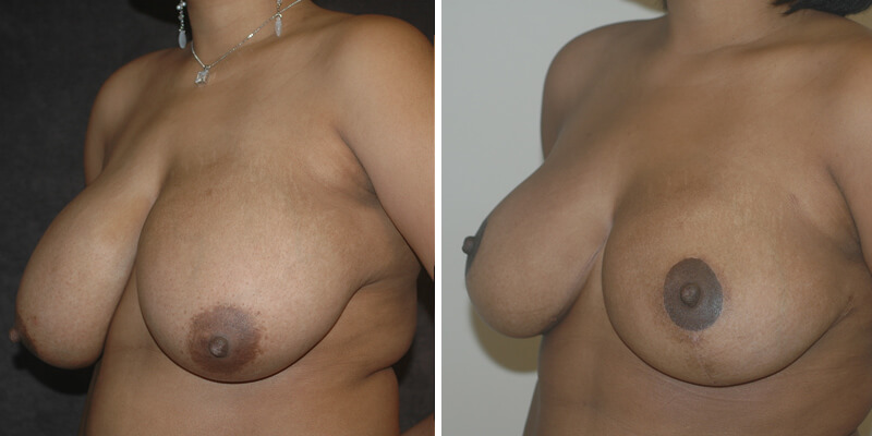 Dr. Kao Breast Reduction