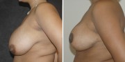 Dr. Kao Breast Reduction