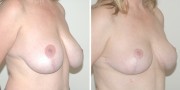 Dr. Kao Breast Reduction