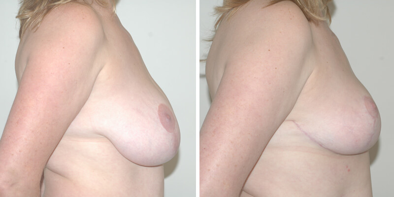 Dr. Kao Breast Reduction