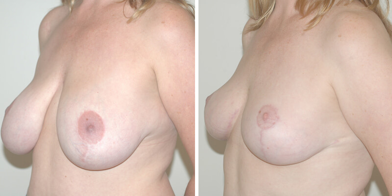 Dr. Kao Breast Reduction