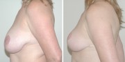 Dr. Kao Breast Reduction