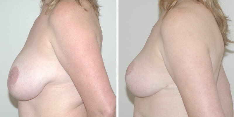 Dr. Kao Breast Reduction