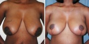 Dr. Kao Breast Reduction