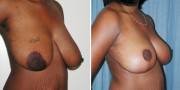 Dr. Kao Breast Reduction