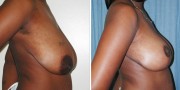 Dr. Kao Breast Reduction