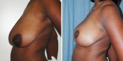 Dr. Kao Breast Reduction