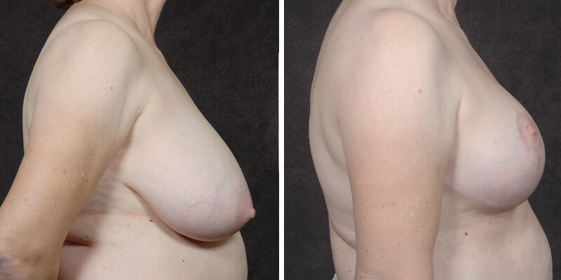 Dr. Kao Breast Reduction