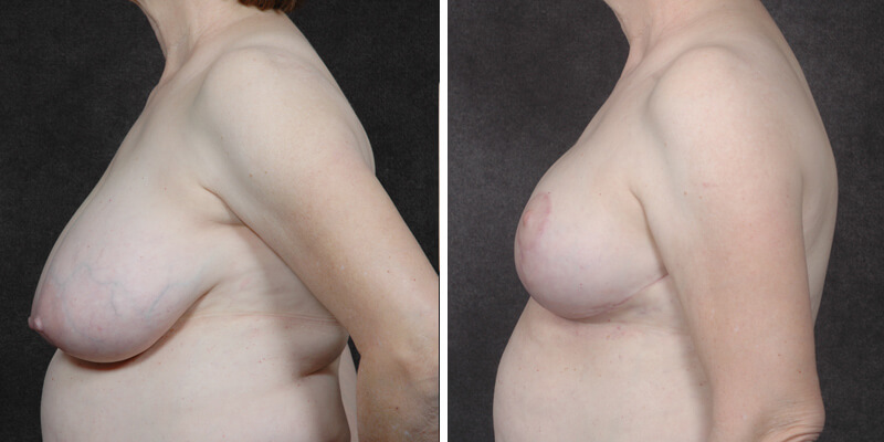 Dr. Kao Breast Reduction