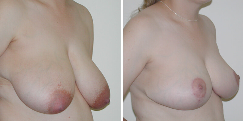 Dr. Kao Breast Reduction