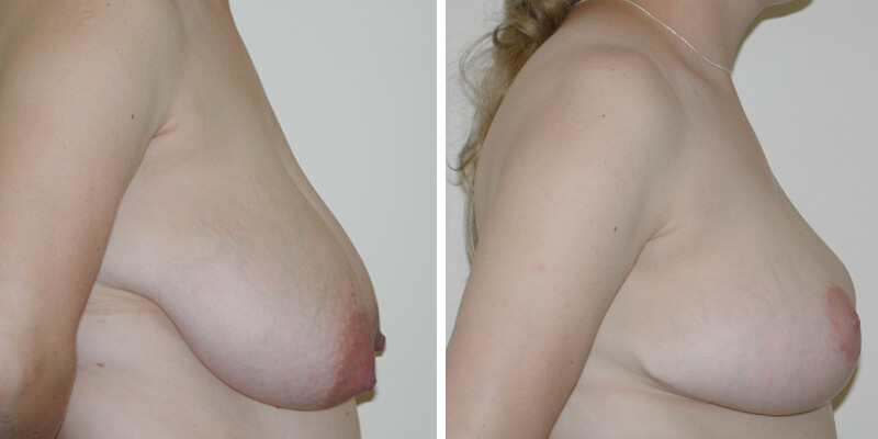 Dr. Kao Breast Reduction