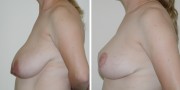 Dr. Kao Breast Reduction