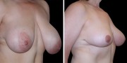 Dr. Kao Breast Reduction