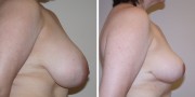 Dr. Kao Breast Reduction