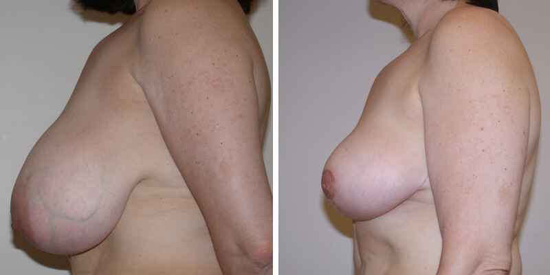 Dr. Kao Breast Reduction