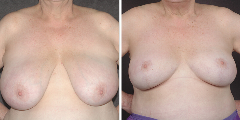 Dr. Kao Breast Reduction