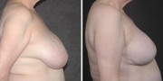 Dr. Kao Breast Reduction