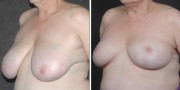 Dr. Kao Breast Reduction