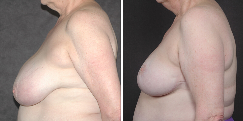 Dr. Kao Breast Reduction