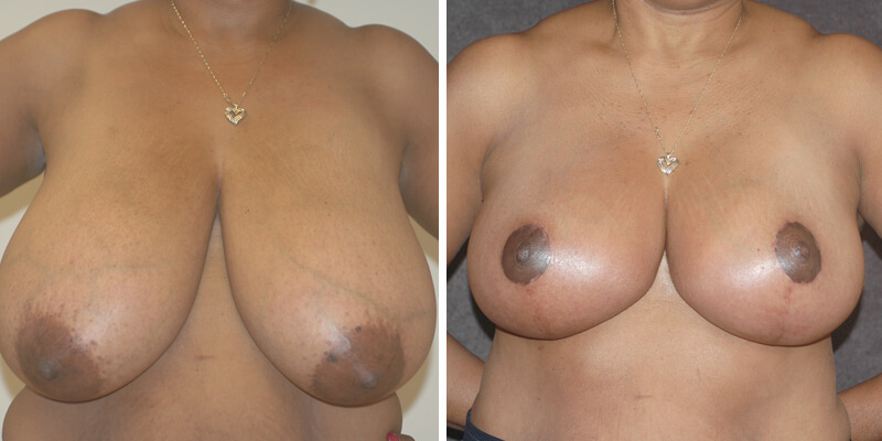 Dr. Kao Breast Reduction