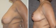 Dr. Kao Breast Reduction