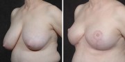 Dr. Kao Breast Reduction