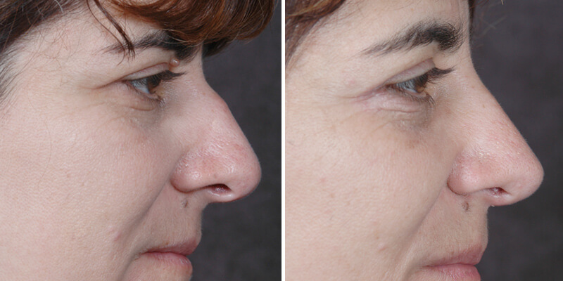 Dr. Kao Rhinoplasty