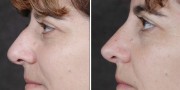 Dr. Kao Rhinoplasty