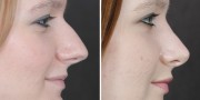 Dr. Kao Rhinoplasty