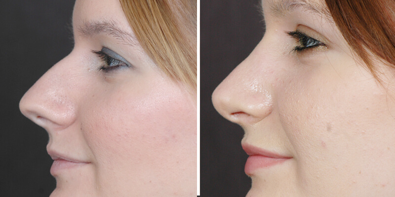 Dr. Kao Rhinoplasty