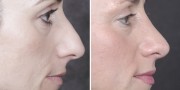 Dr. Kao Rhinoplasty