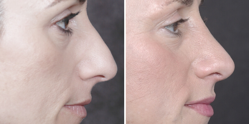 Dr. Kao Rhinoplasty