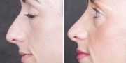 Dr. Kao Rhinoplasty