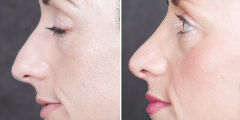 Dr. Kao Rhinoplasty