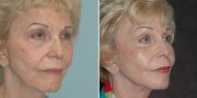 Dr. Kao Ponytail Facelift