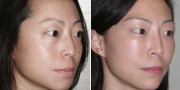 Dr. Kao Ponytail Facelift