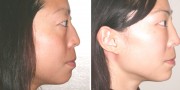 Dr. Kao Ponytail Facelift