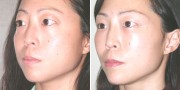 Dr. Kao Ponytail Facelift