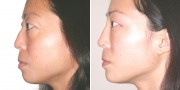 Dr. Kao Ponytail Facelift