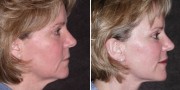 Dr. Kao Ponytail Facelift