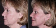 Dr. Kao Ponytail Facelift