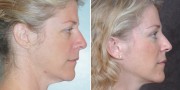 Dr. Kao Ponytail Facelift