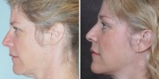 Dr. Kao Ponytail Facelift