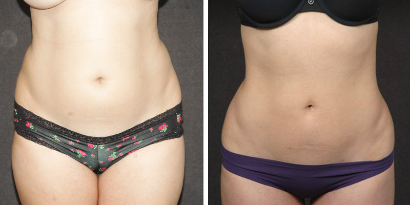 Liposuction - Los Angeles, CA