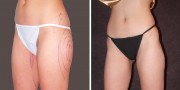 Dr. Kao Liposuction