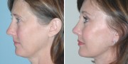 Dr. Kao Ponytail Facelift