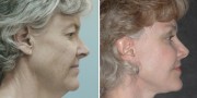 Dr. Kao Ponytail Facelift